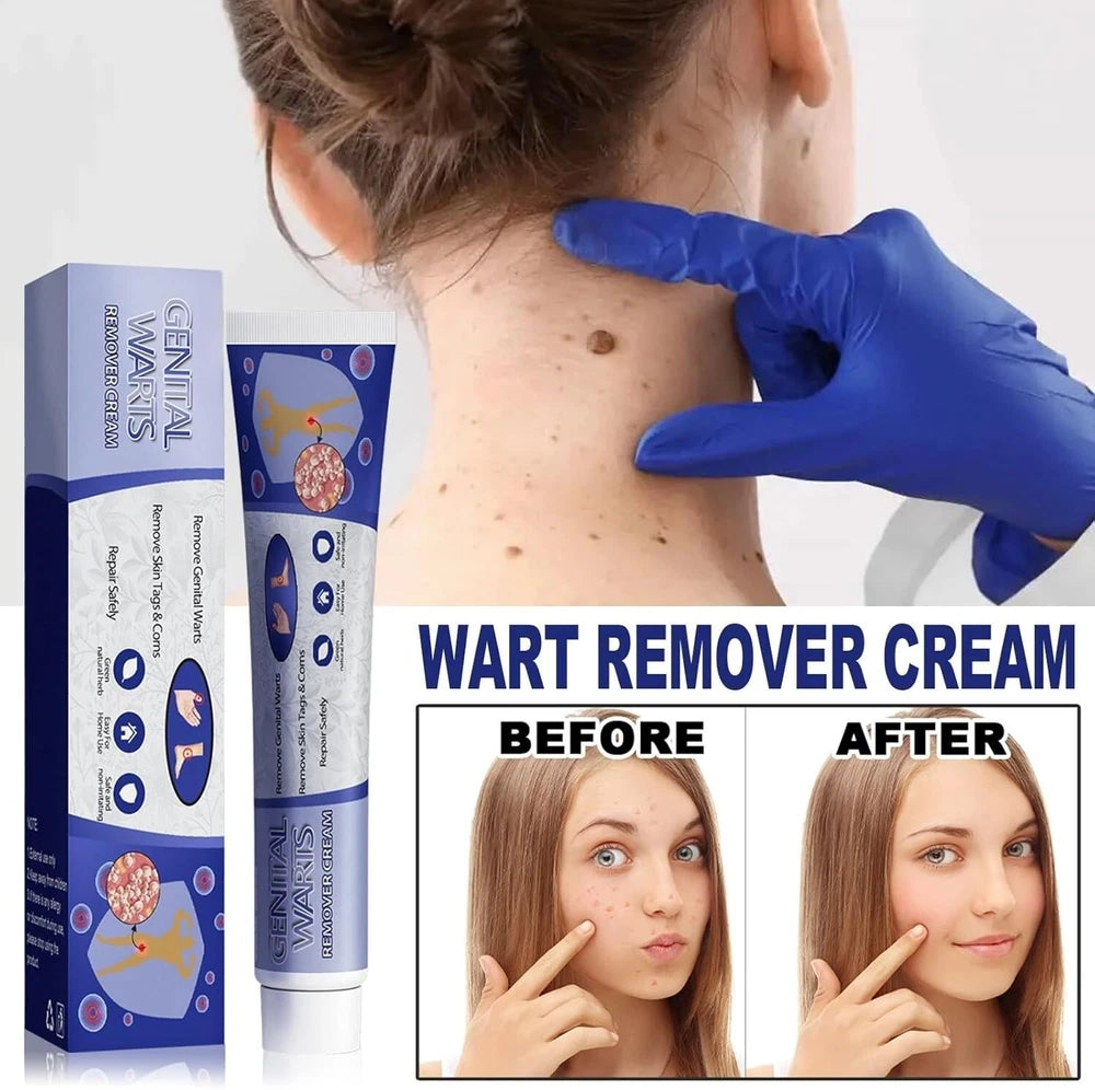 Skin Tag Mole Wart Remover Removal Cream Ointment Fast Safe Natural Treatment