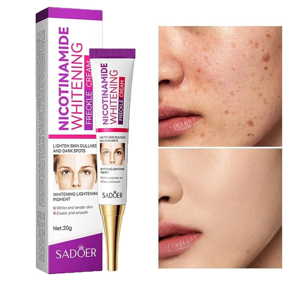 Dark Spot Melasma Hyperpigmentation Freckles Spots Removal Face Cream  Effective