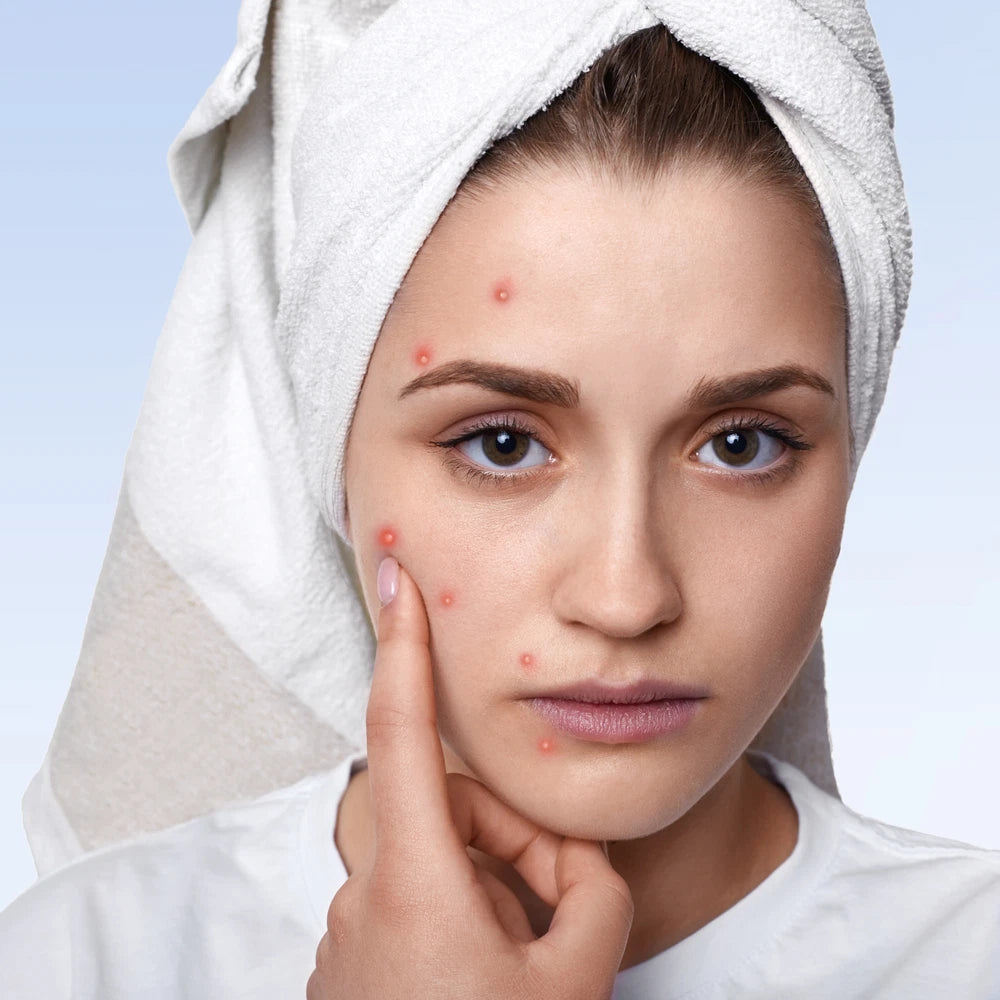 Teens Salicylic Acid Cream Safe On Spots, Blackheads Blemishes & Pimples UK Made