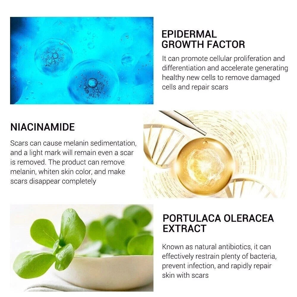 Breylee Acne Scar Removal Cream 30G Face Cream Skin Repair Skin Care Scar Acne