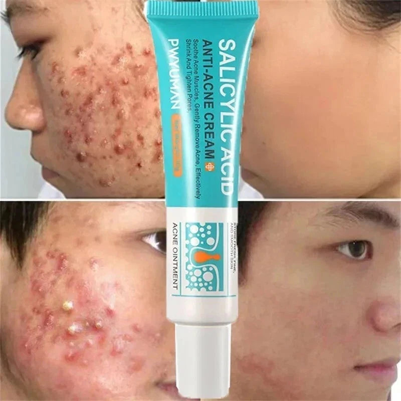 Salicylic Acid Strong Acne Removal Cream Anti Acne Pimple Scars Spots Clean Uk