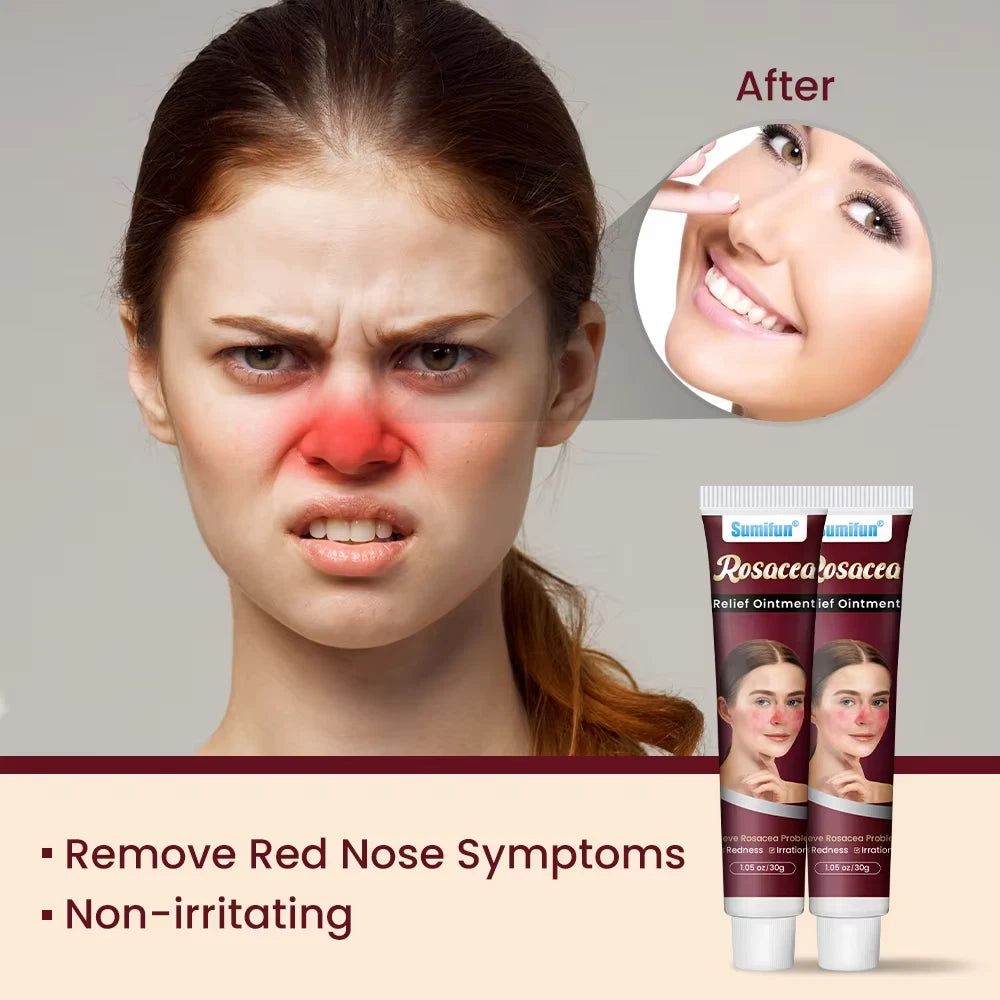 New 30g Natural Herbal Red Face Skin Care Rosacca Cream Red Skin Relief Ointment