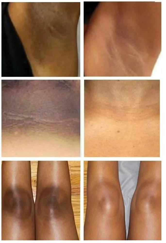 Dark Skin Bleaching Cream Whitening Lightening AHA - Face & Body |- 15g