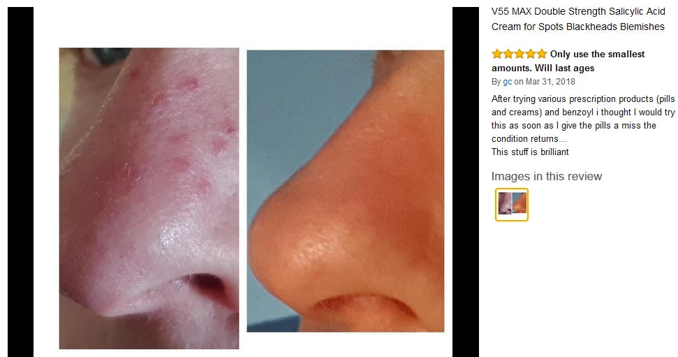 V55 MAX Salicylic Acid Skin Cream Safe on Spots Blackheads Blemishes Pimples