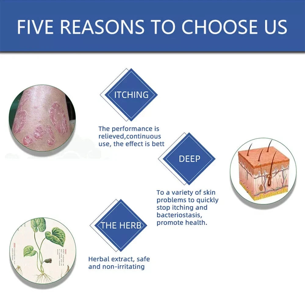 Natural Psoriasis Cream for Dermatitis Eczematoid Eczema Skin Ointment Treatment