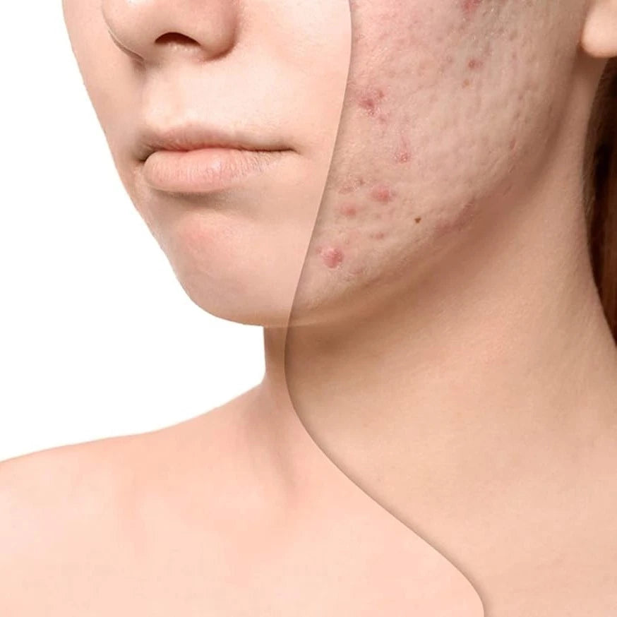 Miaflora 30ml Rosehip Oil 100% Organic Best Facial Oil