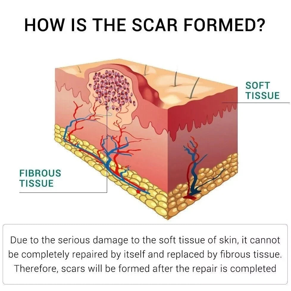 Breylee Acne Scar Removal Cream 30G Face Cream Skin Repair Skin Care Scar Acne