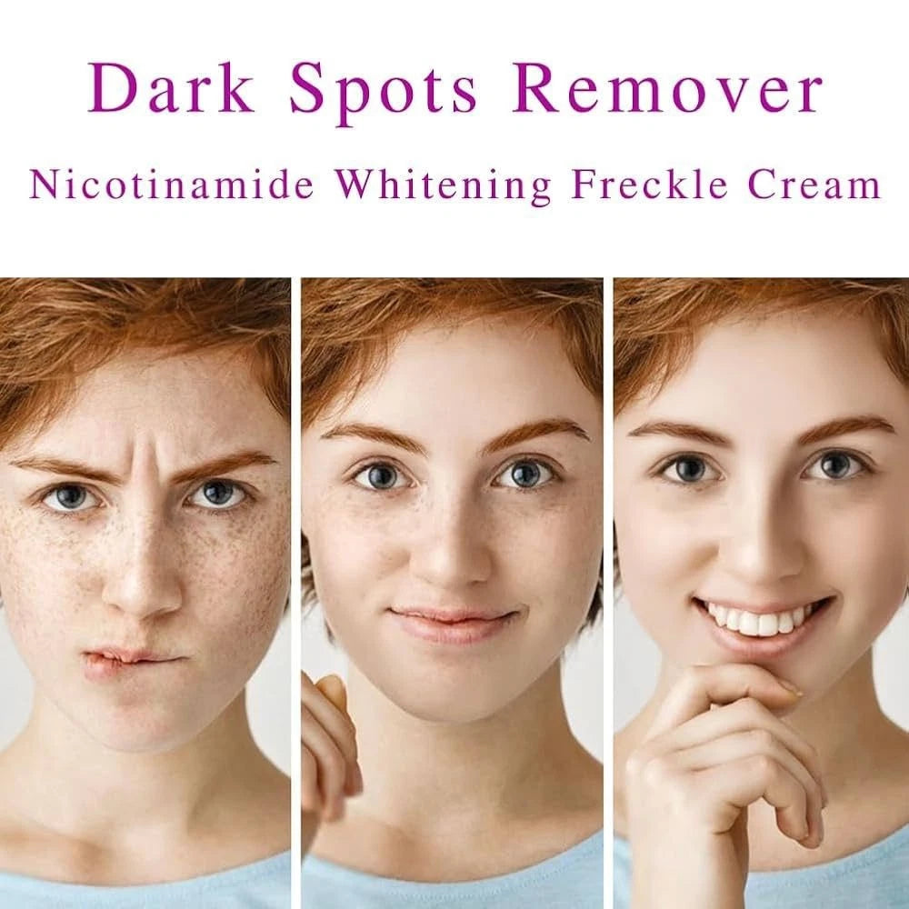 Dark Spot Niacinamide Lighting Melasma Cream Effectively Freckles Remover Cream