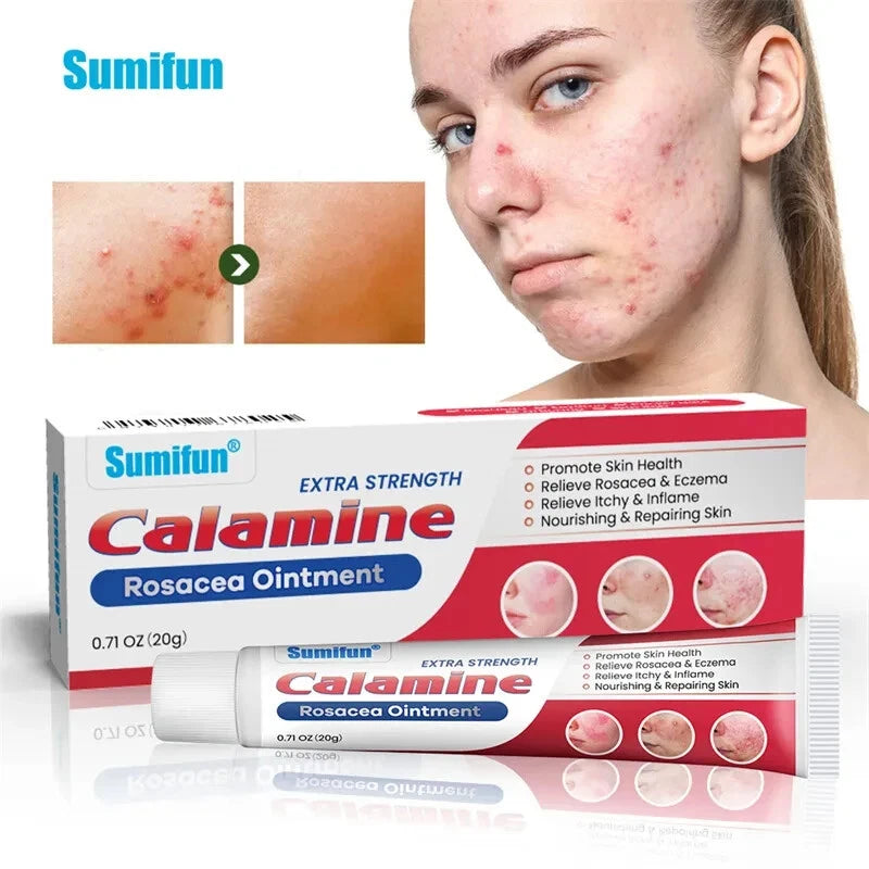 20g New Rosacea Ointment Treat Red Nose Acne Cream Pimple Scar Repair Skin Care