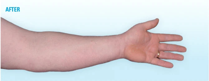 Salytar - 3% Salicylic Acid & 6% Coal Tar Ointment for Dry Skin Moisturizing 30g